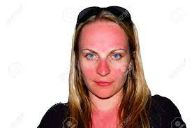 Ne pas appliquer sur une peau irritée ou endommagée, ou sur les muqueuses. Drole Coups De Soleil A La Recherche Sur Le Visage D Une Fille Qui N Etait Pas Couvert Par Lunettes De Soleil Isolee Sur Fond Blanc Banque D Images Et Photos Libres De Droits Image