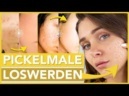 | pickelmale ganz einfach loswerden #beautyhacks #beautytipps #pickelmale #fy | pickelmale schnell loswerden | mit nur 2 zutaten, die jeder zu hause hat | 1 kartoffel reiben |. Pickelmale Einfach Sicher Und Schmerzfrei Zuhause Selbst Entfernen
