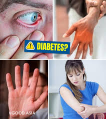 Symptoms when blood sugar is high. High Blood Sugar 16 Warning Signs And 8 Early Diabetes Symptoms Ugood