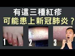 This is 伊波拉病毒的真相：cnn製作 by otakuarmy on vimeo, the home for high quality videos and the people who love them. ä¸­ è‹±å­—å¹• æœ‰é€™3ç¨®ç´…ç–¹å‡ºç¾ å¯èƒ½å·²æ‚£ä¸Šæ–°å† è‚ºç‚Ž If You Have This Rash You May Have Caught Covid 19 å† è‚º56 Youtube