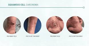 How can i check for the early signs of skin cancer? How Radiation Causes And Treats Skin Cancer Gentlecure