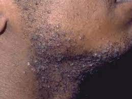 Ingrown hair is a common condition that results from hair removal. How To Prevent Razor Burn The Art Of Manliness