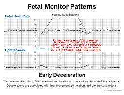 Amicus Illustration Of Amicus Chart Fetal Monitor Heart Rate