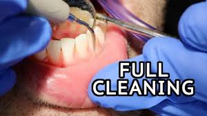 These advanced degrees can help dental hygienists obtain positions extending outside of the dental office, such as those in teaching and research. How Teeth Are Cleaned At The Dentist Youtube