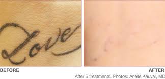 In addition, many of our laser tattoo removal patients are in the process of enlisting in the military (thank you!!), and new requirements prohibit visible tattoos. Picoway Tattoo Removal Dr D Neal Mastruserio Md Llc