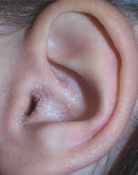 Image result for Acute Otitis Externa