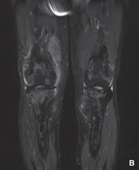 Manifestaciones Osteoarticulares De Las Histiocitosis Del Adulto Sciencedirect