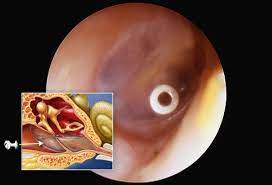 Anatomy Of An Ear Infection Ear Tubes Ear Infection Ear Infection Symptoms
