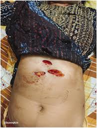 Enhancing trauma evaluation: Comparative analysis of post-mortem computed  tomography and autopsy findings in abdominal stab wounds - Darshan Galoria,  Srushti Shukla, Shridhar Dave, Preeti Tiwari, Prateek Rastogi, Pradeep  Rana, Dhara Goswami, Arijit