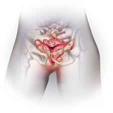 Current research suggests this cancer begins in the fallopian tubes and moves to the ovaries, the twin organs that produce a woman's eggs and the main source of the female hormones estrogen and progesterone. Difference Between Ovarian Cysts And Fibroids Advanced Gynecology