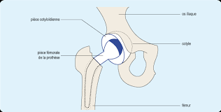 In the most common surgery to repair a femur fracture, the surgeon inserts a rod or large nail into the center of the bone. Traitement Chirurgical D Une Fracture Du Col Du Femur Ameli Fr Assure