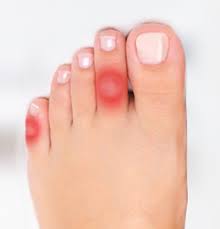 Il contribue à diminuer les douleurs à la marche, en réduisant les pressions sur les tissus du pied. Comment Proteger Et Soigner Cors Oeils De Perdrix Et Durillons Urgo