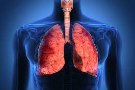 Stanford Researchers New Test For Cystic Fibrosis May Lead To More Treatments