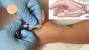 De Quervain S Tenosynovitis Swelling