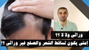 الفرق بين الصلع الوراثي و التساقط الغير وراثي تحديد نوع تساقط الشعر Youtube