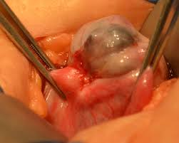 Tubal Ligation Cause Side Effects A Tubal Specialist S Experience