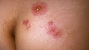 Herpes on the Buttocks: Symptoms, Pictures, and Treatments
