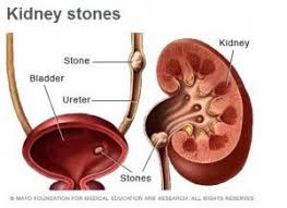Weekend Wellness Family History Of Kidney Stones Increases Risk Kidney Stones Kidney Stones Symptoms Kidney