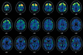 Ct scans and mri scans are two medical imaging methods that create detailed images of internal body parts, including bones, joints, and organs. Abnormal Levels Of A Protein Linked To C T E Found In N F L Players Brains Study Shows The New York Times