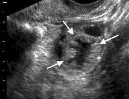 Image result for corpus luteum sonography)