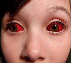 Answers here is the real link. Case Of A Subconjunctival Bleeding In An Otherwise Healthy Child R Medizzy