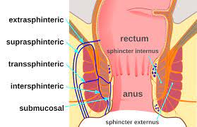 Fistula definition a fistula is a permanent abnormal passageway between two organs in the body or between an organ and the exterior of the body. Anal Fistula Wikipedia