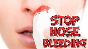 This Is The Easiest Way To Stop A Nose Bleeding Healthy Food News Nose Bleeds Nasal Allergies Dry Nose