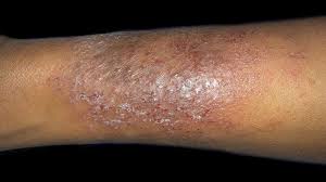 Image result for Dry Skin