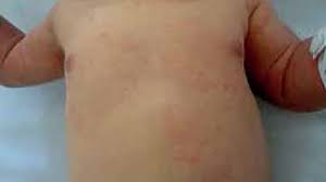 Image result for sweat rash on back baby