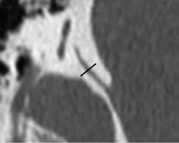 Vestibular Aqueduct Measurements In The 45 Oblique Poschl Plane American Journal Of Neuroradiology