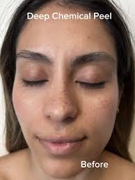 Rhonda Allison Hibiscus Peel Steps