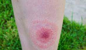 La maladie de lyme : Symptomes Maladie De Lyme Les Differents Symptomes Selon Les Phases De La Maladie Doctissimo