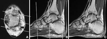 State Of The Art Mr Imaging Techniques For The Foot And Ankle Springerlink