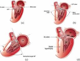 Image result for Left Ventricular Outflow Obstruction