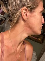 Alright friends, raw moment. Gaaaah this is hard. My struggle with my face  has been super difficult for me over the past several years. I have had to  pack