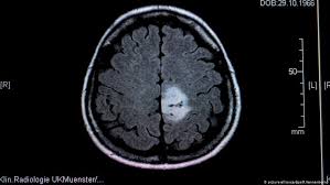 The exact causes of brain cancer is children is unknown, but there are several factors that physicians and researchers believe could lead to the development of cancerous tissue in the brain. Brain Tumors In Children When All That Matters Is Now Science In Depth Reporting On Science And Technology Dw 08 06 2020