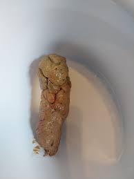 Image result for blood in stool human poop