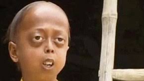 Image result for progeria case in bihar