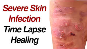 Image result for Skin Infection