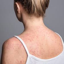 Image result for measles