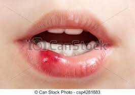 Sår på tungan som inte läker, ofta smärta förstorade lymfkörtlar i munbotten och/eller på halsen vid metastasering inflammatoriska och infektiösa processer premaligna förändringar skavsår från tandproteser eller vassa kanter på tänder granularcellstumör misstänkt tungcancer utreds av. Sar Barn Sar Mun Blod Mansklig Barn Lapp Skada Fysisk Canstock