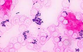 Listeria monocytogenes, a facultative anaerobe, intracellular bacterium, is the causative agent of listeriosis. Listeria Monocytogenes