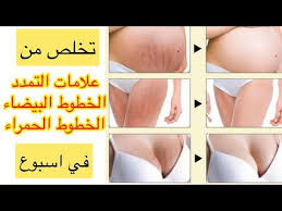 تخلص من علامات التمدد الخطوط البيضاء الخطوط الحمراء في 7 ايام فقط تجربتي بعد الولادة والرضاعة Youtube Pretty Skin Care Body Skin Care Face Skin Care