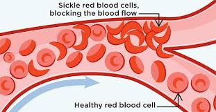 Learn about sickle cell disease, also called sickle cell anemia, and its causes, who is at risk, early symptoms, ways to manage complications, nhlbi research, and how to participate in clinical trials. Sickle Cell Disease Scd Be The Match