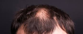 علاج الصلع المبكر وأسباب حدوثه ويب طب