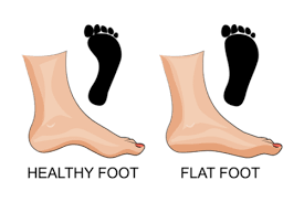 We did not find results for: Flat Feet Facts Symptoms Complications Management Factdr