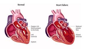 While the loss of vision is often associated with getting older, according to the national eye institute, approximately 11 million americans age 12 or older could impr. Illustration Of A Healthy Heart And One With Heart Failure Download Scientific Diagram