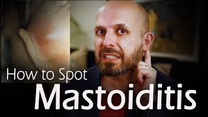 Image result for Mastoiditis