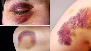 Muskelzerrungen, muskelprellungen, blutergüsse und blaue flecken sind ebenfalls möglichkeiten, die besonders im bereich der beine venenschäden mit sich bringen können. Blutung Wann Sie Mit Einem Blauen Fleck Zum Arzt Mussen Welt