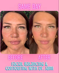 Look what 2 syringes of Radiesse can do! 🤯 🤩 #snatched #facialcontouring  #facialbalancing #radiesse #dermalfillers #injectables #medspa #kcmedspas  #beauty